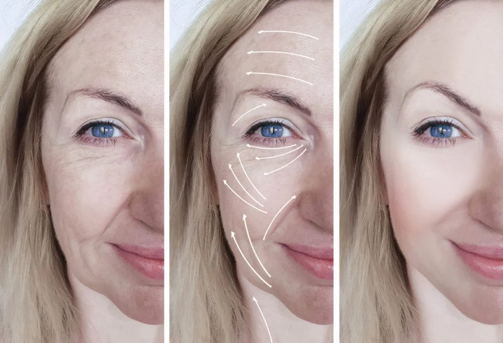 Mild skin tightening