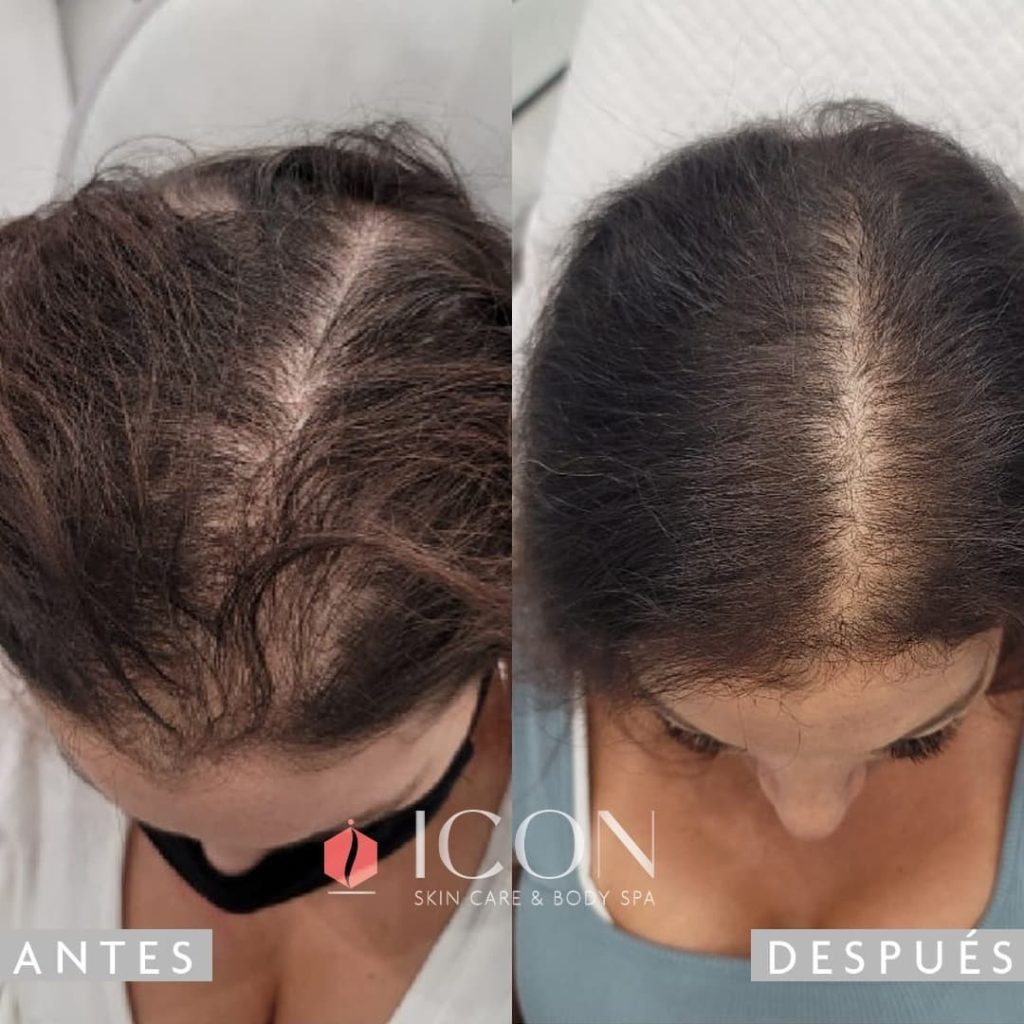 Women hair Lost Treatment