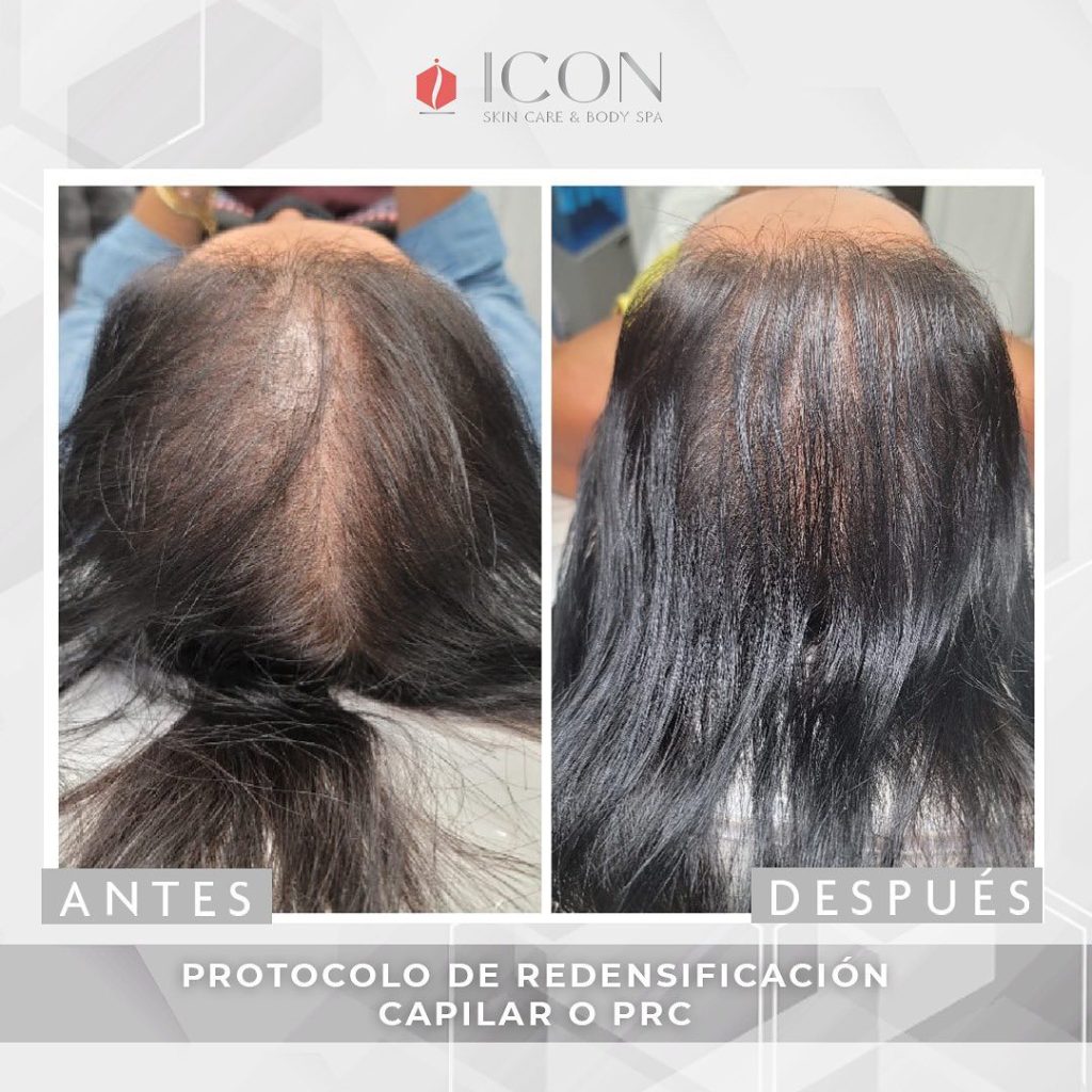 lost-hair-treatment