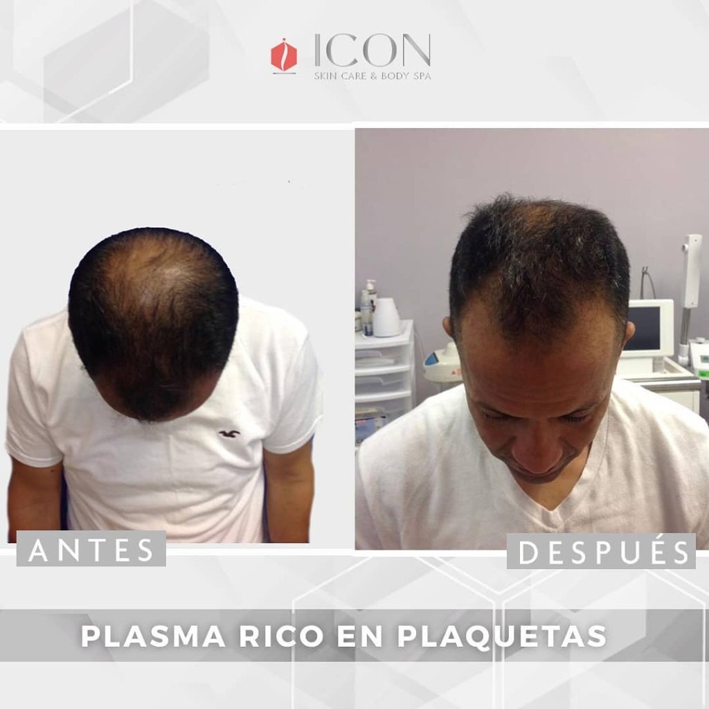 Men Hair Lost Treatment