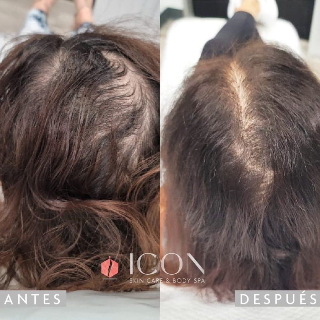 Women hair Lost Treatment